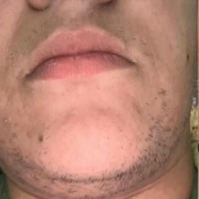 A before image close up of a man 's face with patchy hair  on chin.