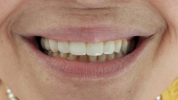 trattamento laser denti