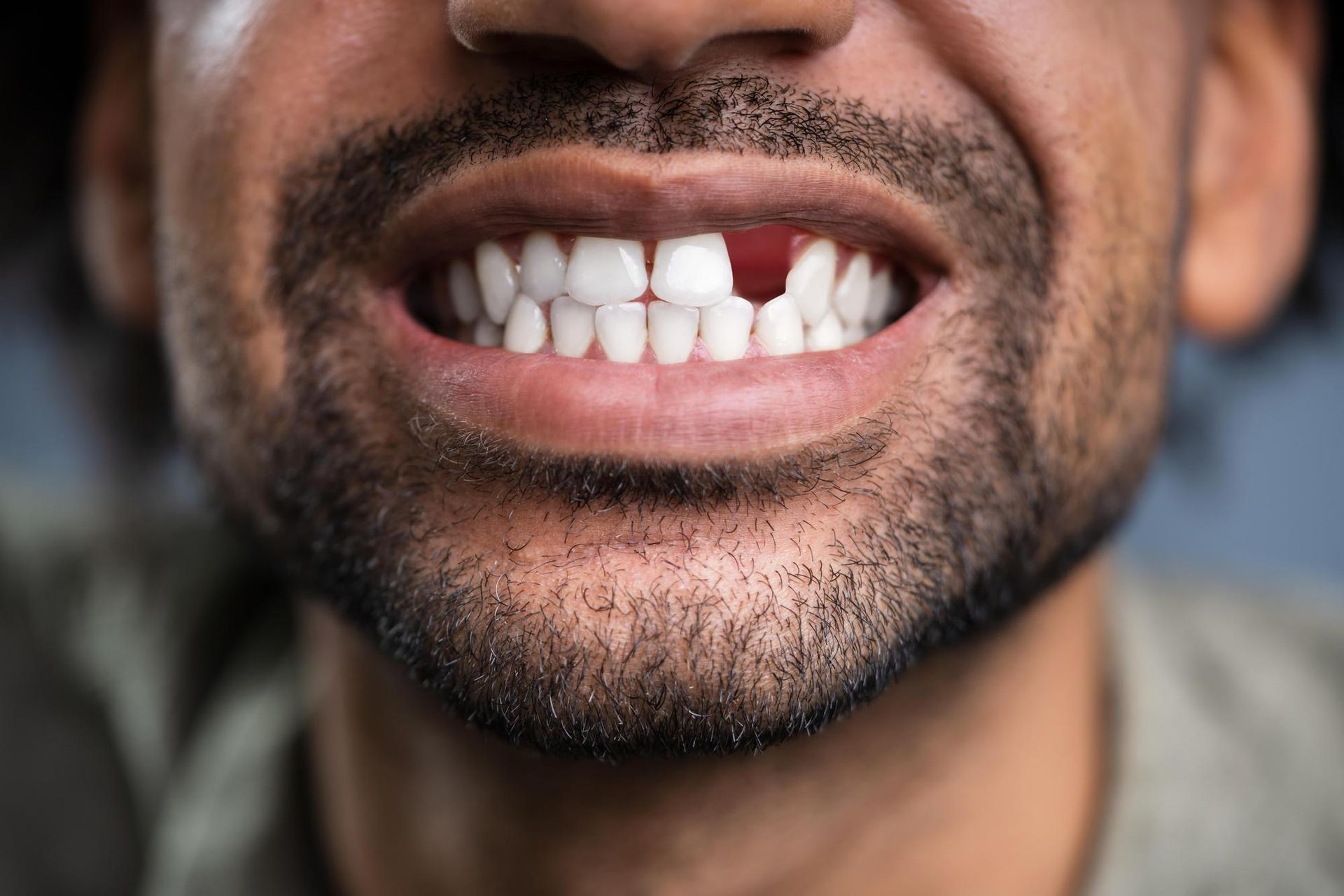 A close up of a man 's mouth with a missing tooth.