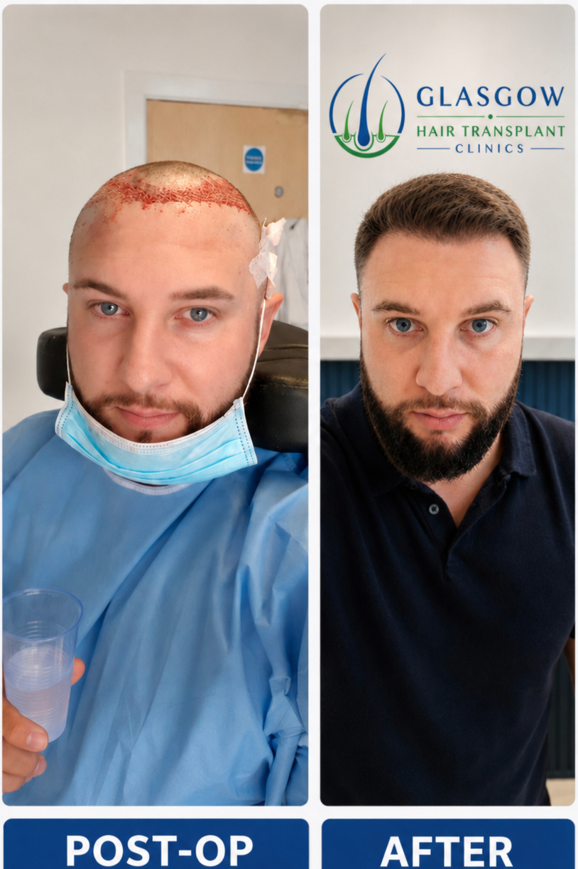 Frontal hair transplant before and after result
