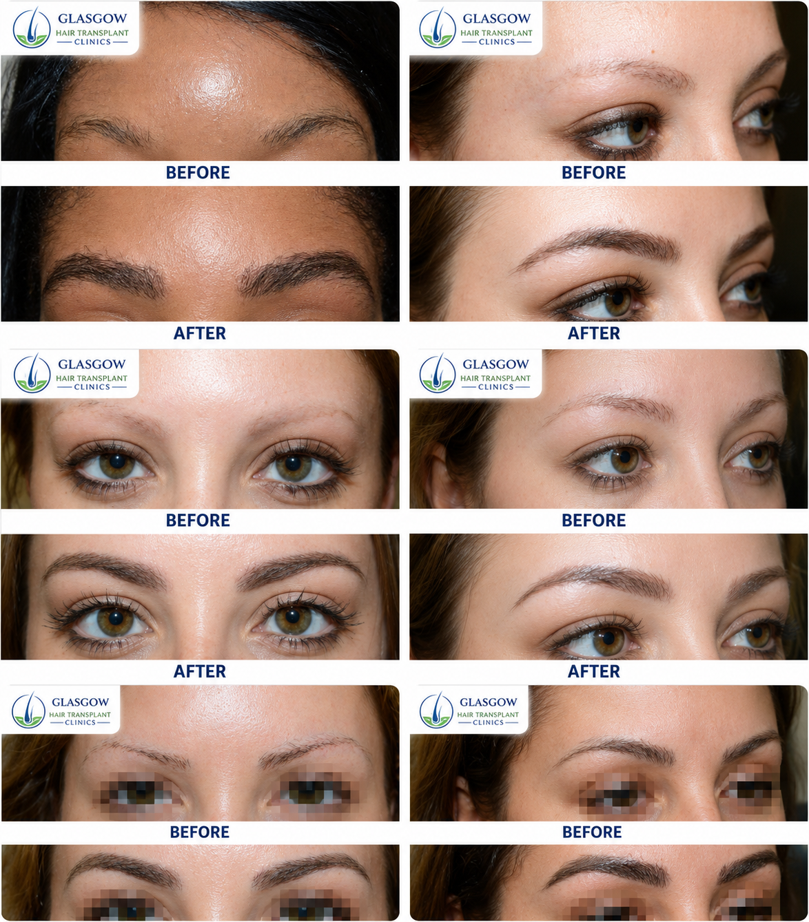 Eyebrow transplant before and after result