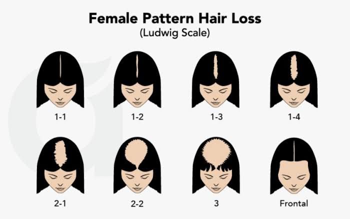 Female pattern hair loss