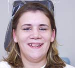 Image of a woman before treatment | Dental veneers in Osborne, KS to repair and reshape teeth.
