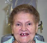 Image of a woman before treatment | Affordable dentures in Osborne, KS to replace missing teeth.