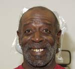 Image of a man before treatment | Custom teeth whitening in Osborne, KS for a brighter smile.