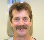 Image of a man before treatment | Durable dental implants in Osborne, KS for lasting results.