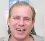 Before Dental Implants and Dentures in St. Louis MO