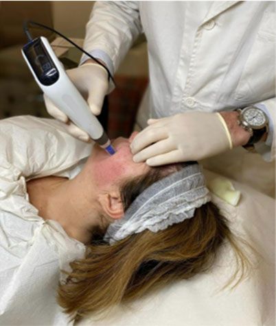 dermapen needling