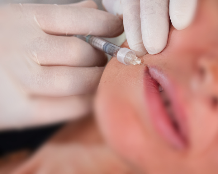 filler labbra