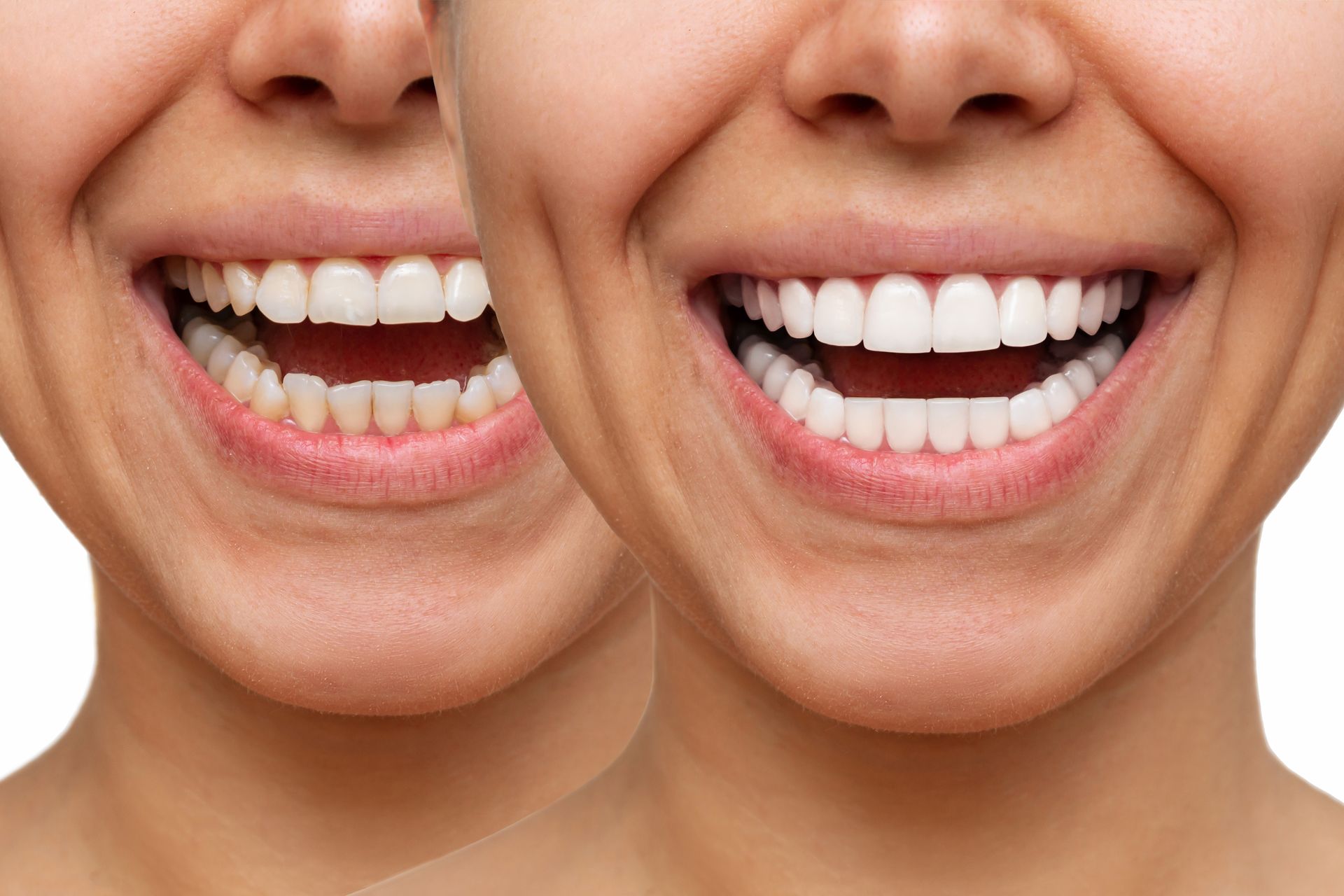 Cropped shot of a young, smiling woman showcasing a before-and-after veneers procedure. Cropped shot of a young, smiling woman showcasing a before-and-after veneers procedure.