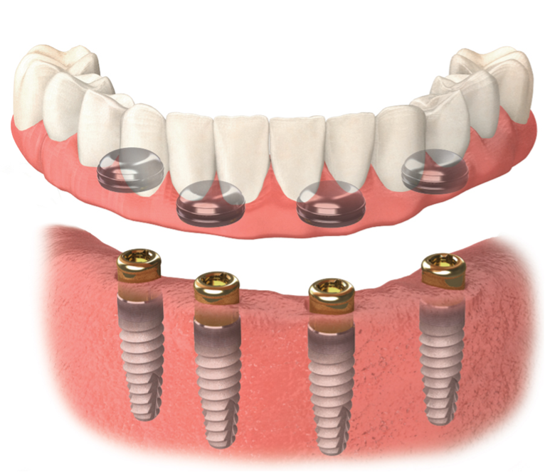 Lower Dental Implant Denture — Precise Dentures in Berserker, QLD