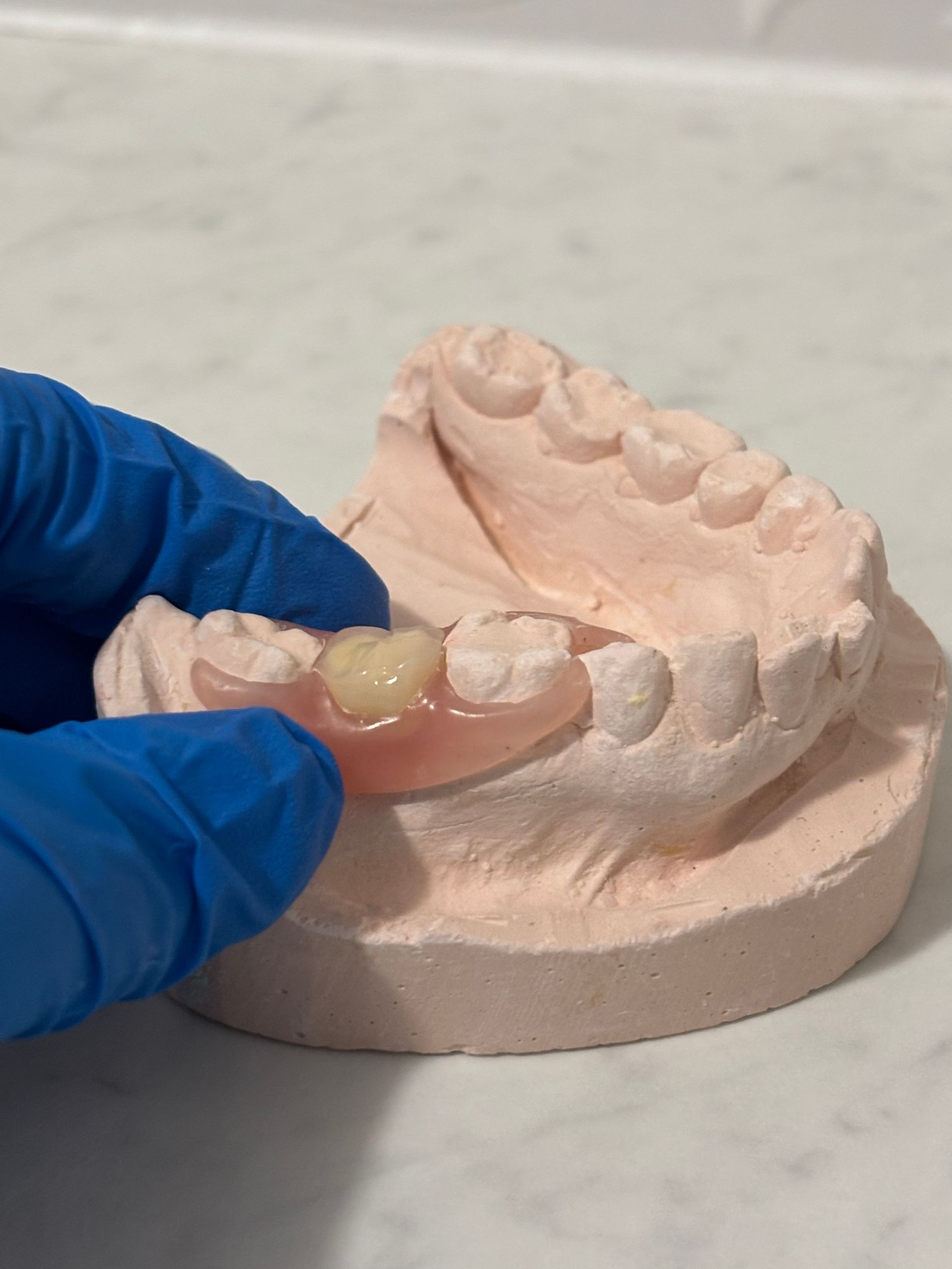 Gloved Hand Holding a Dental Mold With a Tooth-colored Implant — Precise Dentures in Berserker, QLD