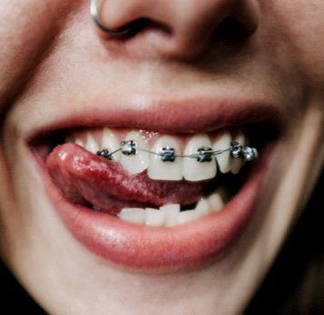 braces