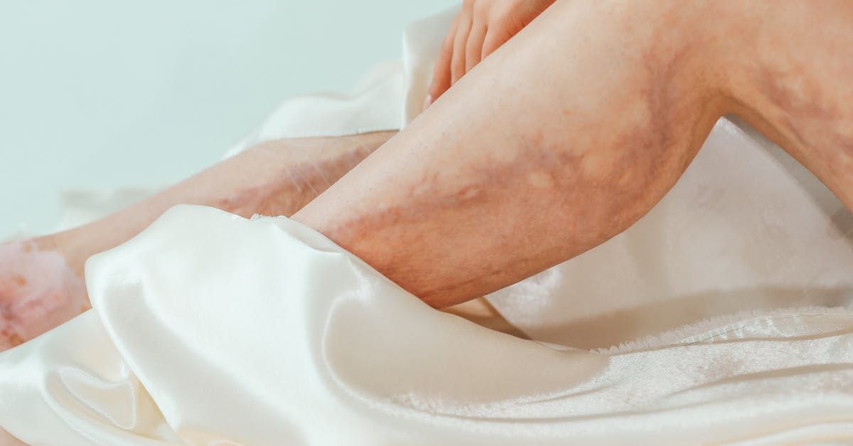 Une personne avec des varices sur les jambes est assise sur un lit.