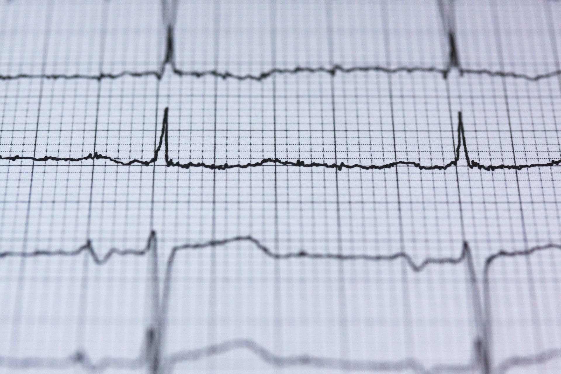 ECG (electrocardiogram) graph paper with a black tracing, showing peaks and valleys representing heart activity.