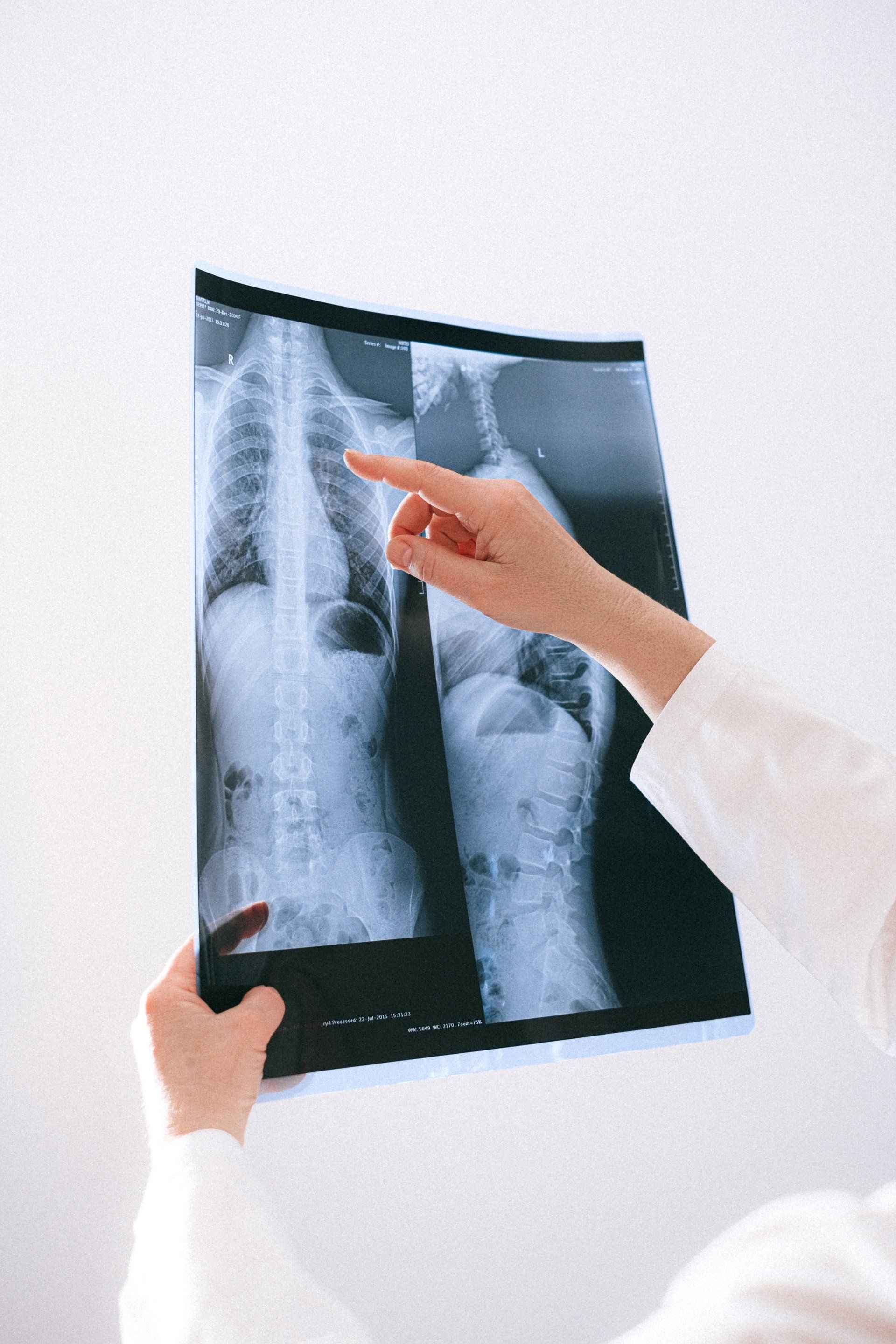 A person is pointing at an x-ray of a person 's chest.