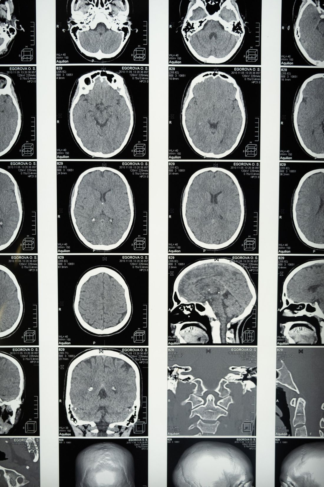 A scan of a brain using Signal IONM