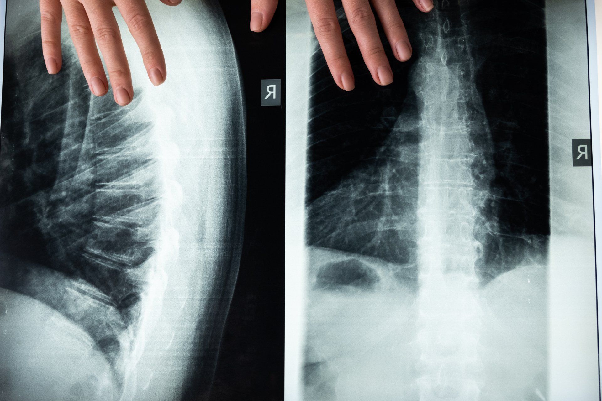 Spinal Cord Injuries