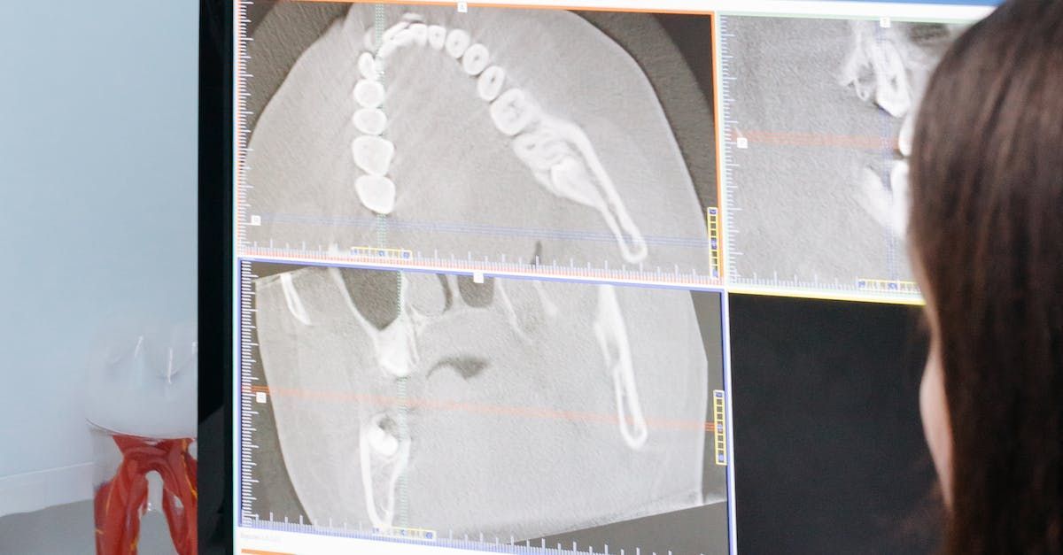X-ray image showing dental implants in the jaw