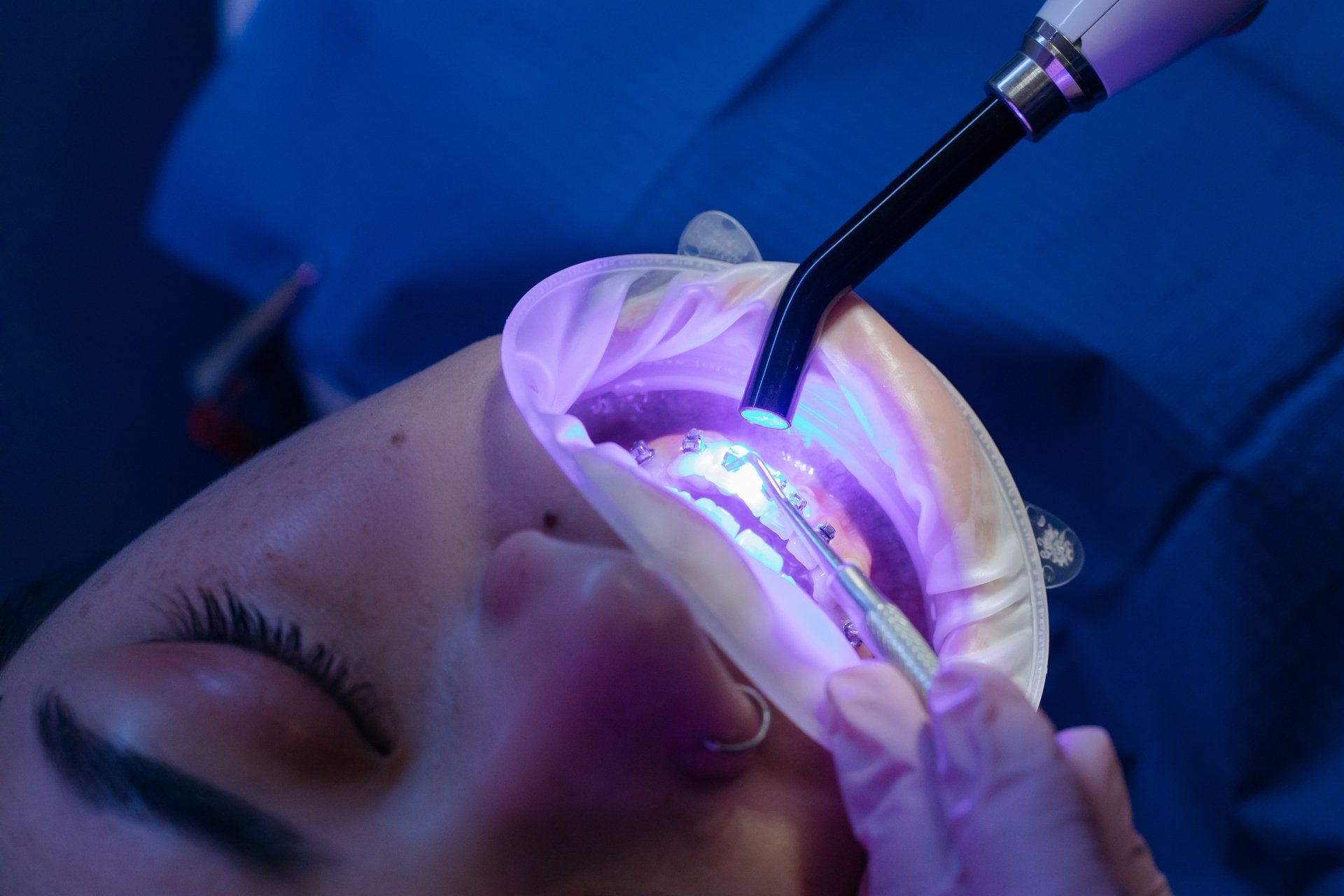 What is Laser Dentistry