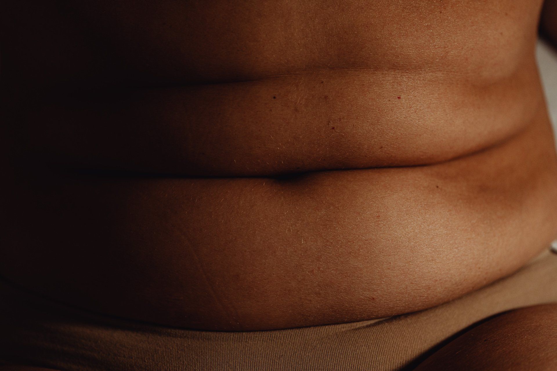 woman-before-tummy-tuck-colombia
