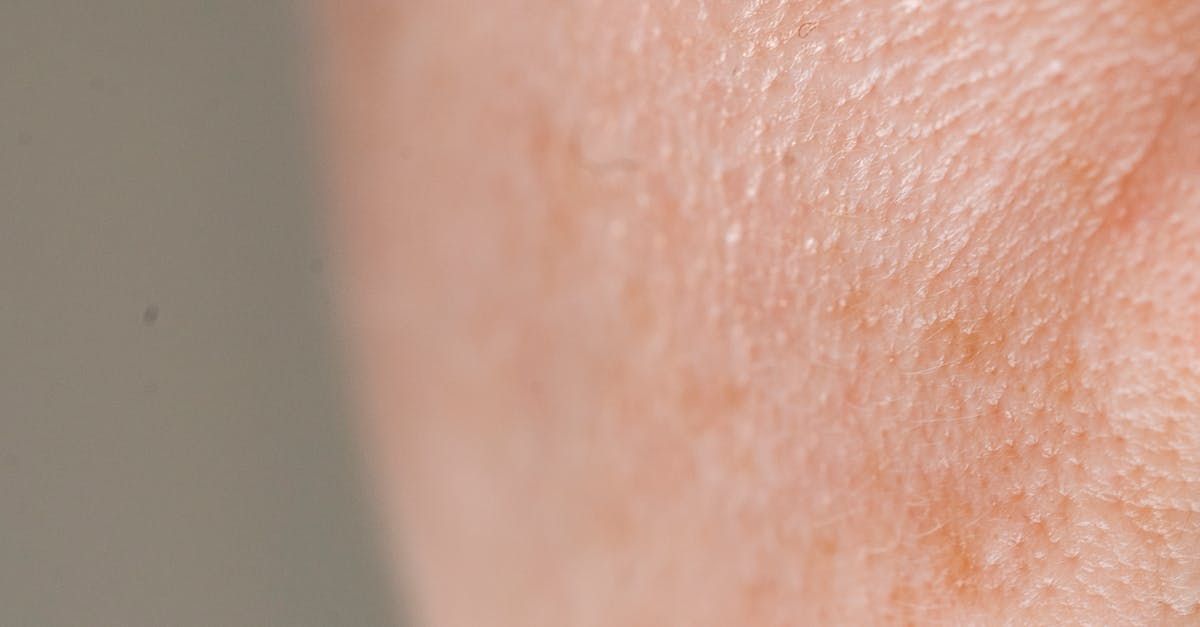 ¿cómo quitar las cicatrices de acné?