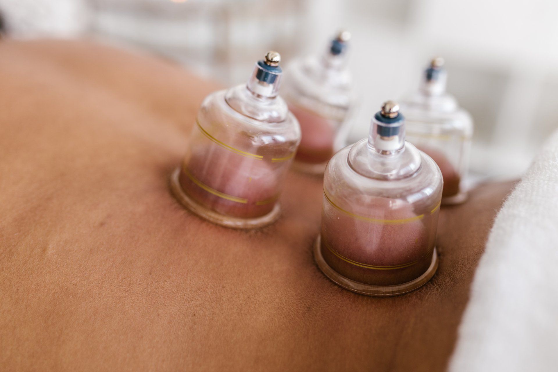 four cupping cups on back