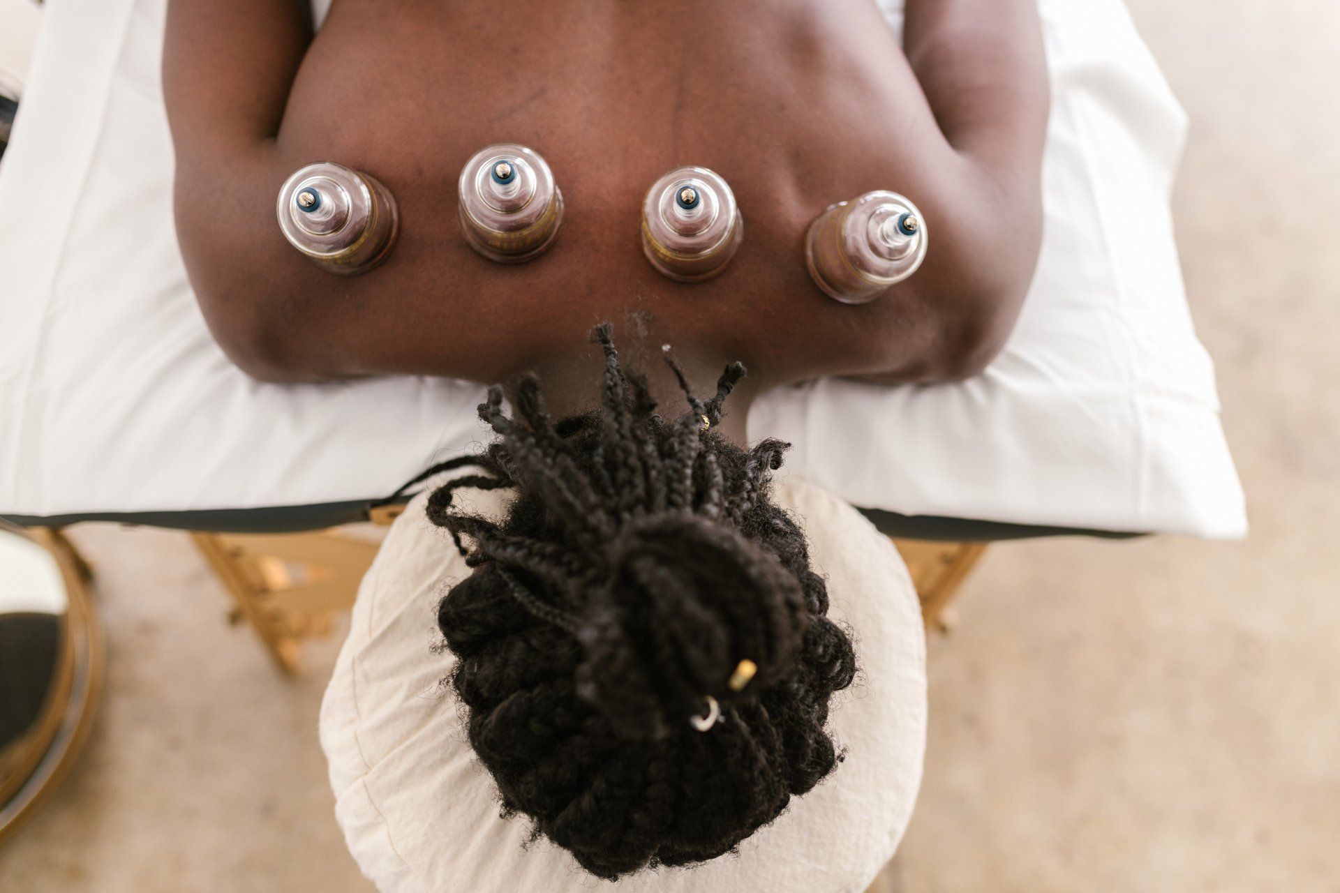 A person lying face down receiving cupping therapy