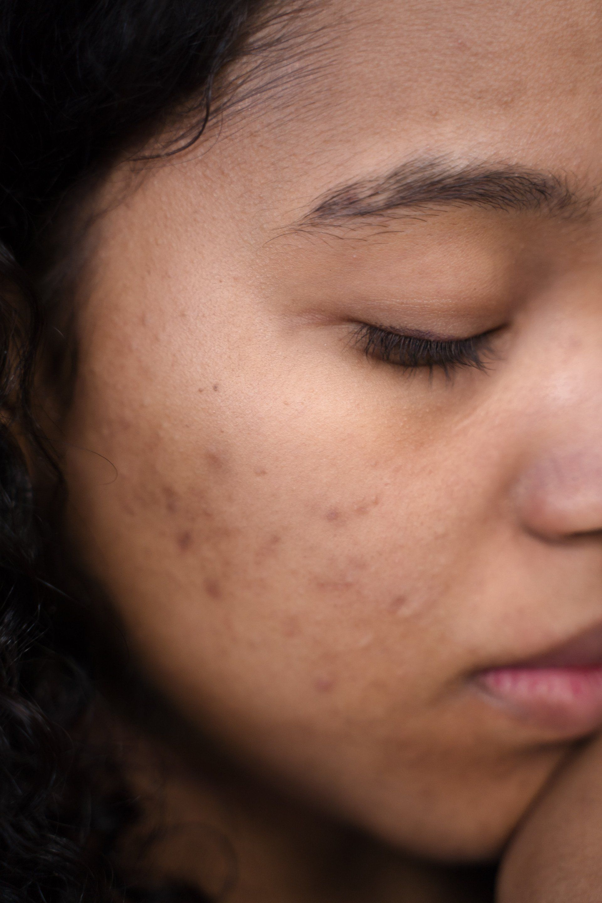 A close up of a woman 's face with acne on it.