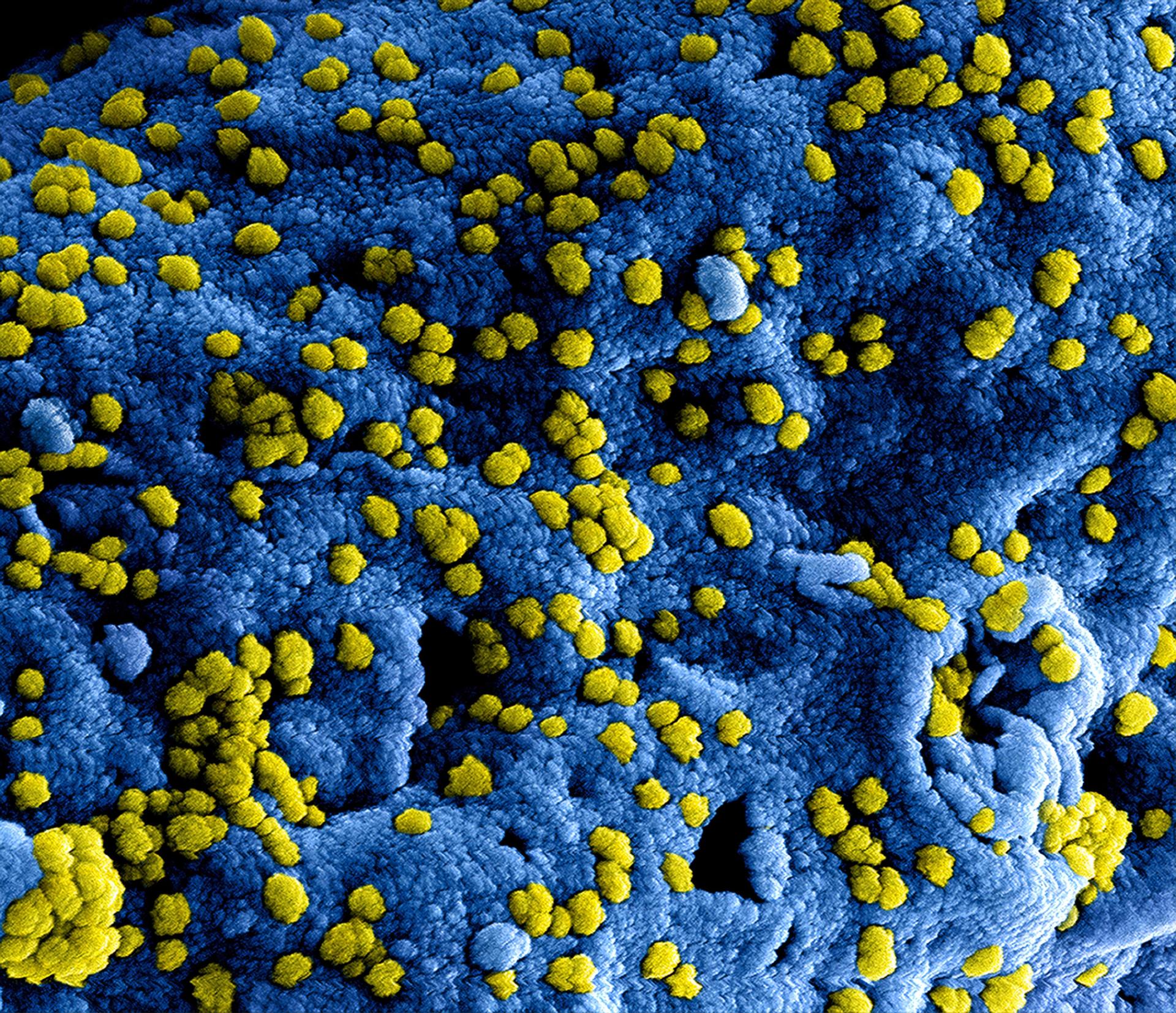 Bactérias aderidas à superfície de um implante. Texto sobre infecção após artroplastia do joelho.