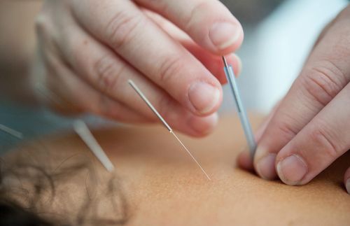 Hands inserting acupuncture needles into a person's back; close up.